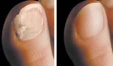 Ayak Tırnağının Kırılması Belirtileri ve Tedavisi Ayak Tırnağının Kırılması Belirtileri ve Tedavisi