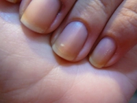 Tırnak Sararması Belirtileri ve Tedavisi Tırnak Sararması Belirtileri ve Tedavisi