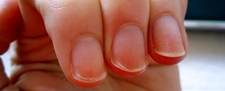 Tırnak Soyulması Belirtileri ve Tedavisi Tırnak Soyulması Belirtileri ve Tedavisi