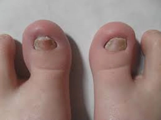 Bebeklerde Tırnak Mantarı Belirtileri ve Tedavisi Bebeklerde Tırnak Mantarı Belirtileri ve Tedavisi