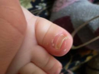 Çocuklarda Tırnak Mantarı Belirtileri ve Tedavisi Çocuklarda Tırnak Mantarı Belirtileri ve Tedavisi