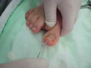 Tırnak Çekilmesi Belirtileri ve Tedavisi Tırnak Çekilmesi Belirtileri ve Tedavisi